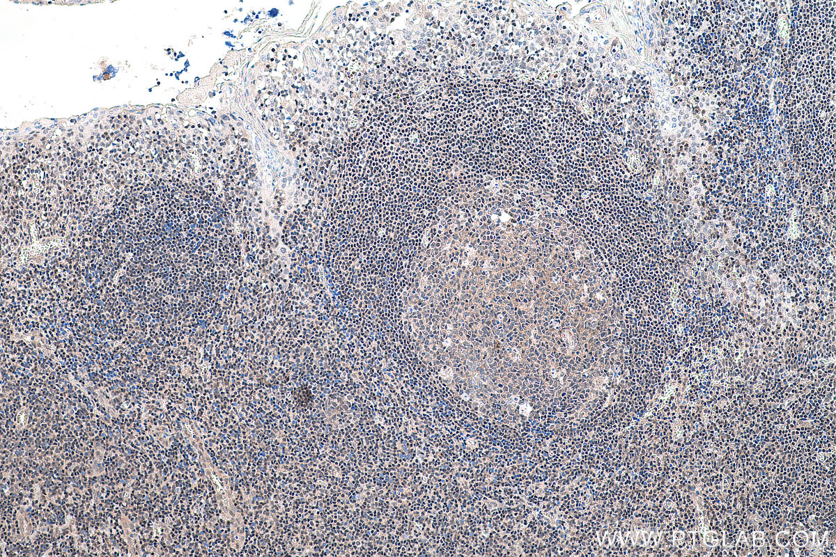 IHC staining of human tonsillitis using 66281-1-Ig