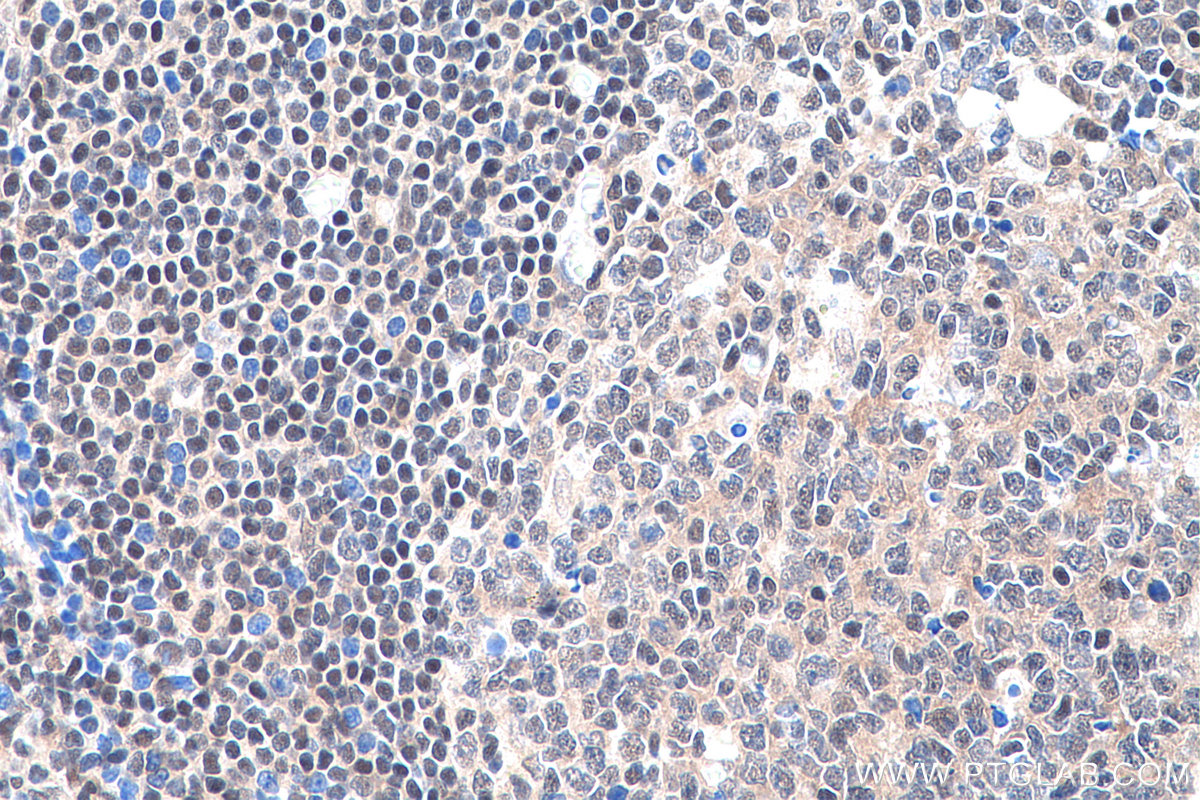 IHC staining of human tonsillitis using 66281-1-Ig