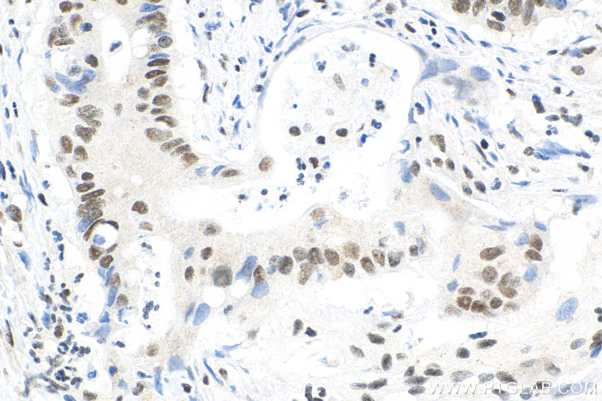 IHC staining of human colon cancer using 66281-1-Ig