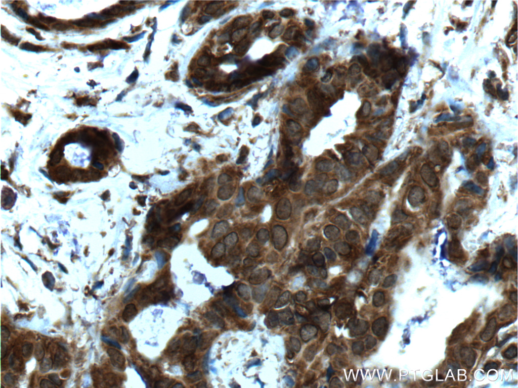IHC staining of human breast cancer using 66281-1-Ig