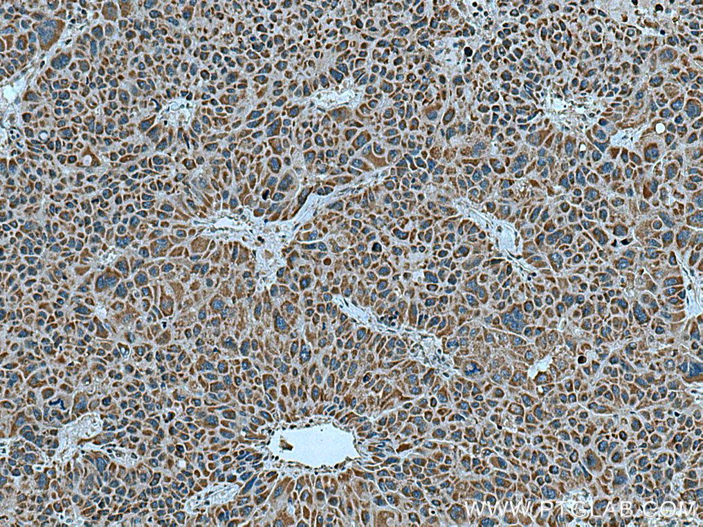 IHC staining of human liver cancer using 14945-1-AP