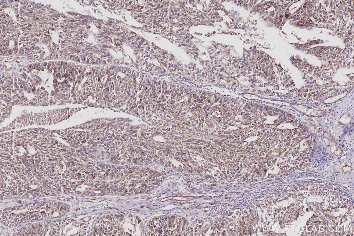 IHC staining of human ovary cancer using 28761-1-AP