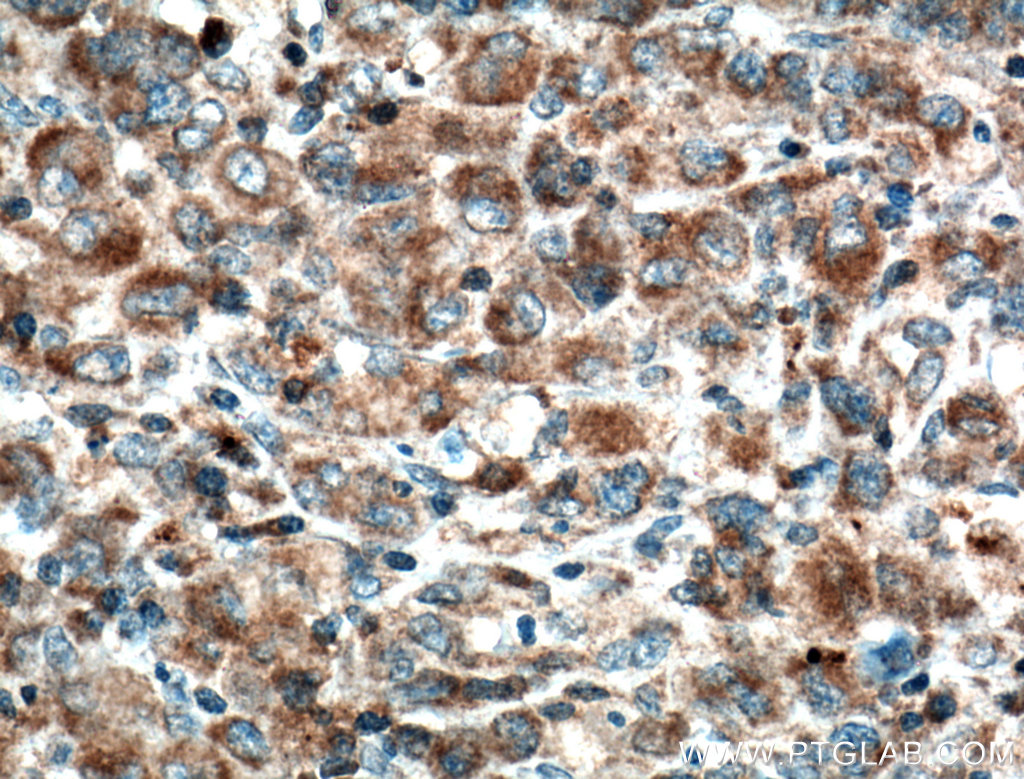 IHC staining of human lymphoma using 60200-1-Ig