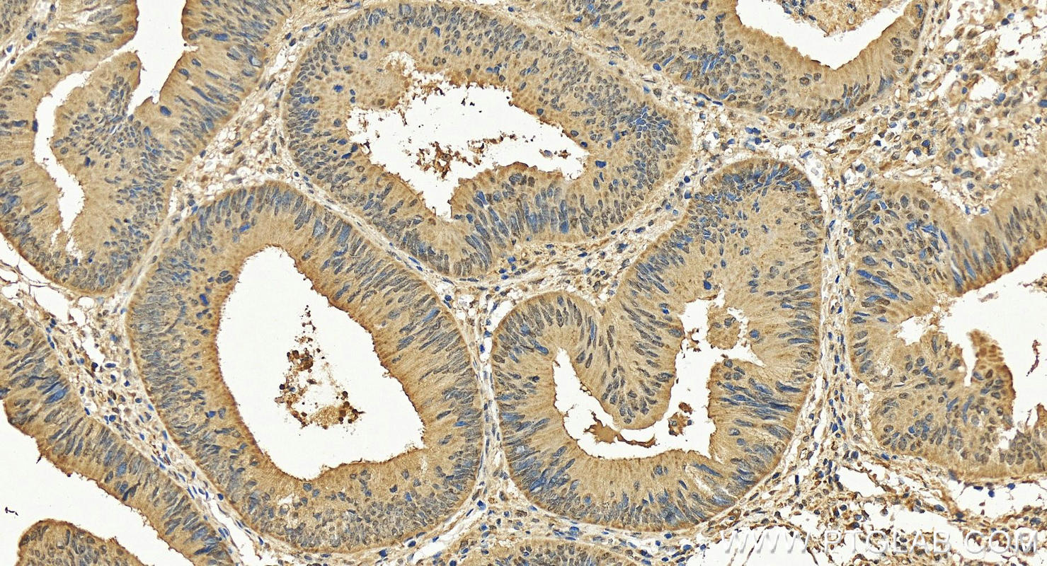 IHC staining of human colon cancer using 84396-2-RR (same clone as 84396-2-PBS)
