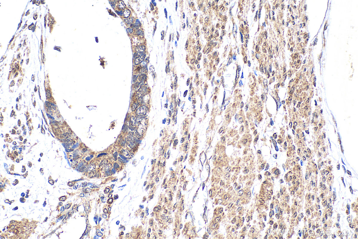Immunohistochemical analysis of paraffin-embedded human urothelial carcinoma tissue slide using 25215-1-AP (ZBTB11 antibody) at dilution of 1:200 (under 40x lens). Heat mediated antigen retrieval with Tris-EDTA buffer (pH 9.0). IHC staining of human urothelial carcinoma using 25215-1-AP