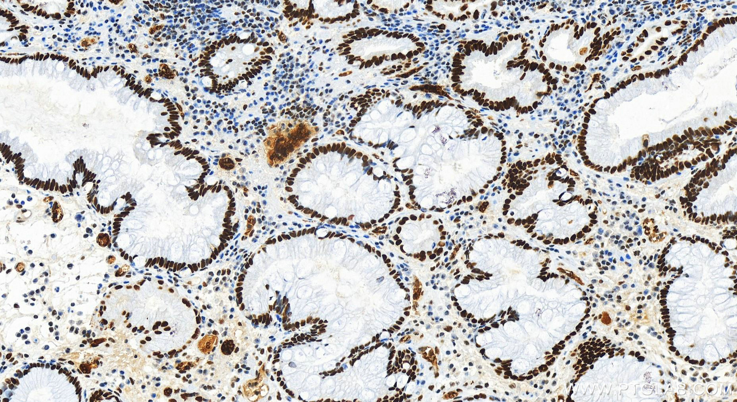 IHC staining of human stomach cancer using 83616-5-RR (same clone as 83616-5-PBS)