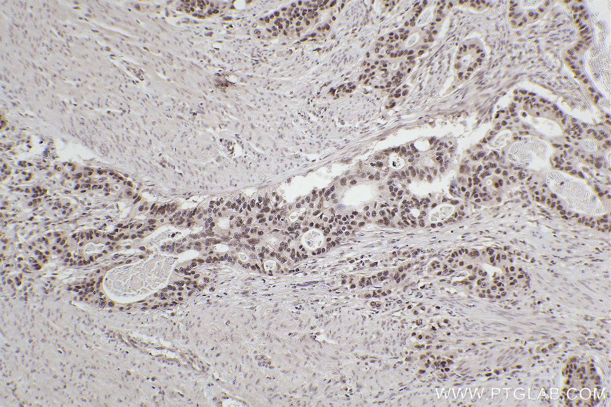 IHC staining of human stomach cancer using 68526-1-Ig
