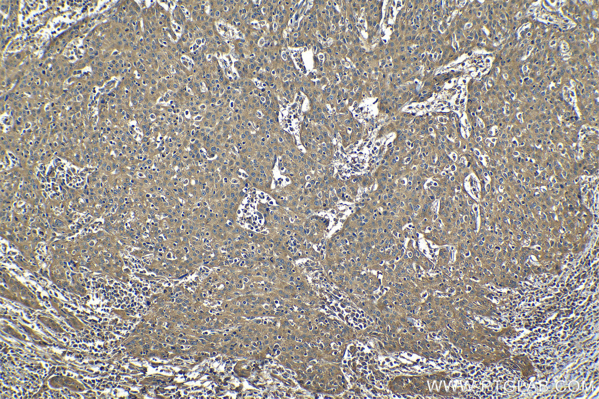 IHC staining of human cervical cancer using 26241-1-AP