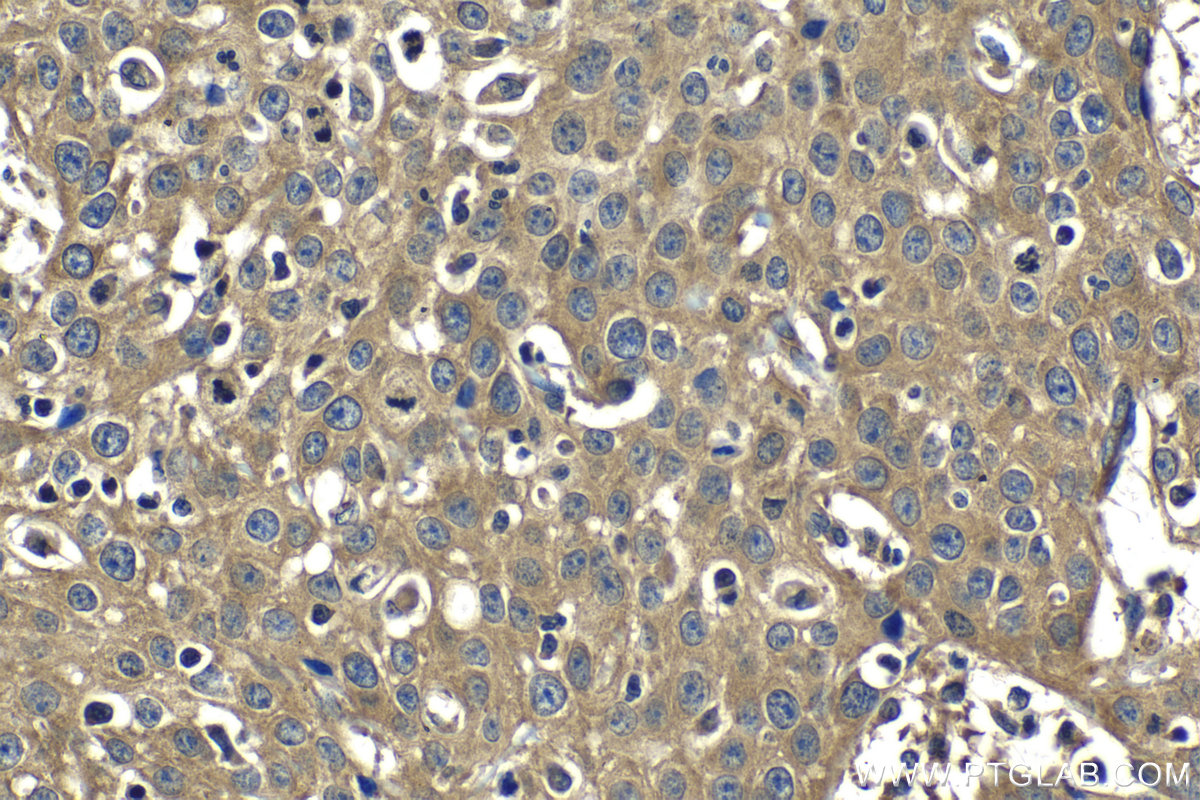 IHC staining of human cervical cancer using 26241-1-AP