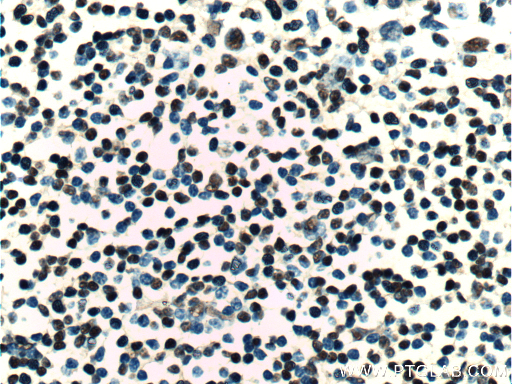 IHC staining of human tonsillitis using 25807-1-AP