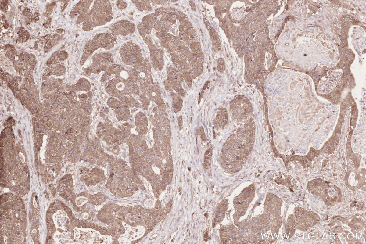 IHC staining of human stomach cancer using 16820-1-AP IHC staining of human stomach cancer using 16820-1-AP