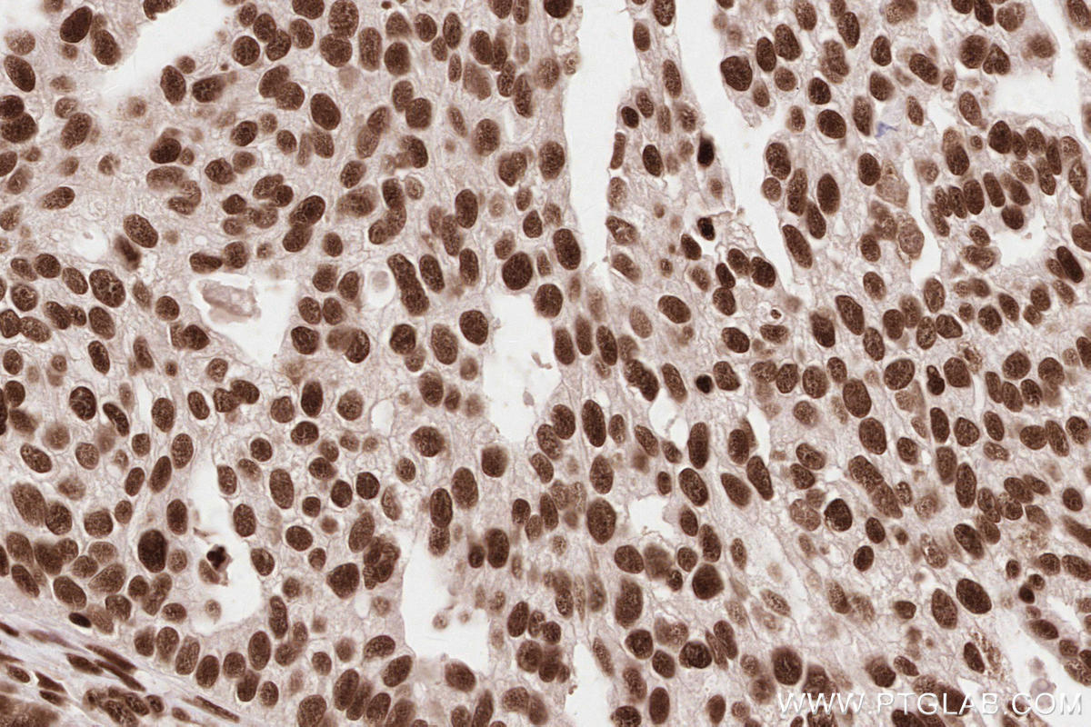 IHC staining of human ovary cancer using 23374-1-AP