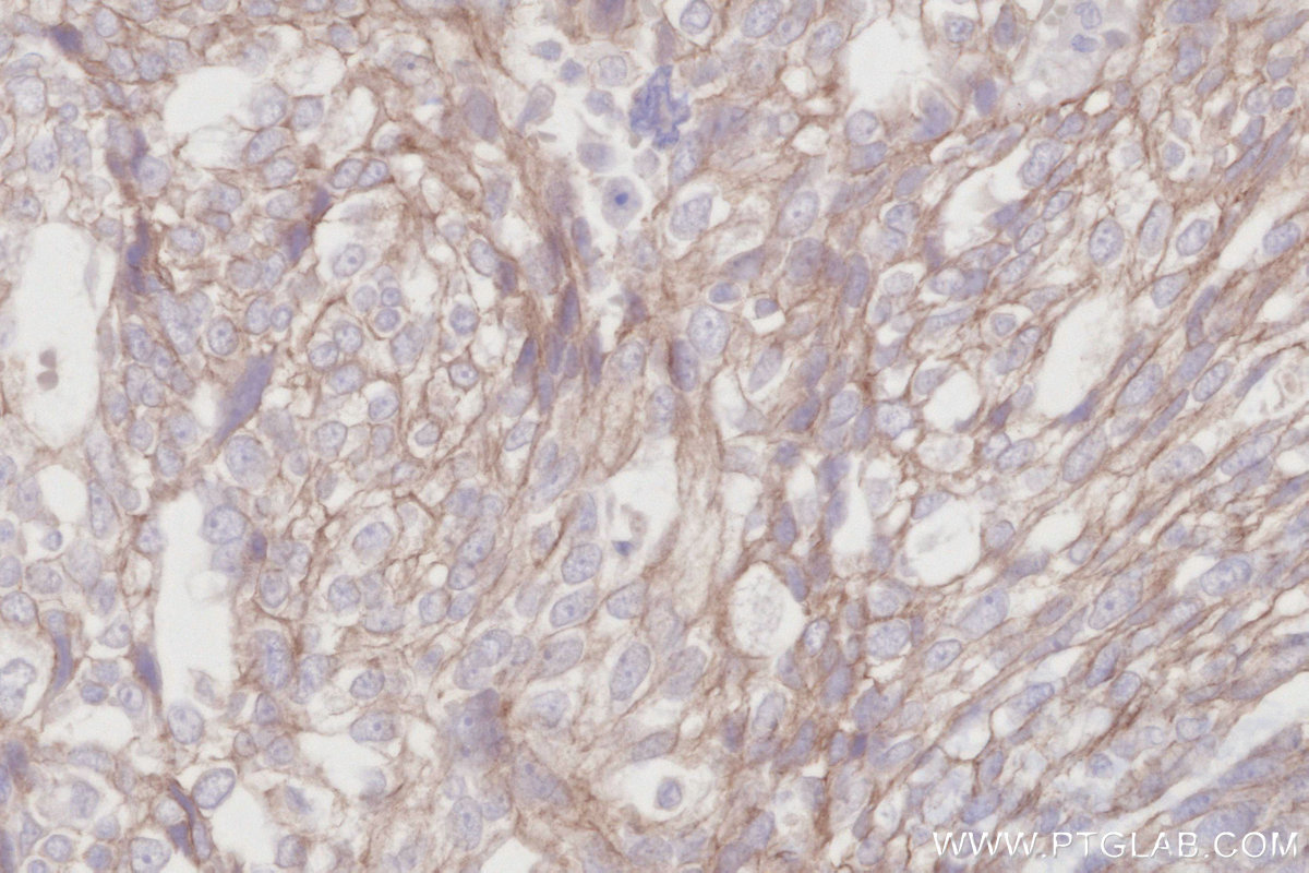 IHC staining of human ovary cancer using 84803-4-RR (same clone as 84803-4-PBS)