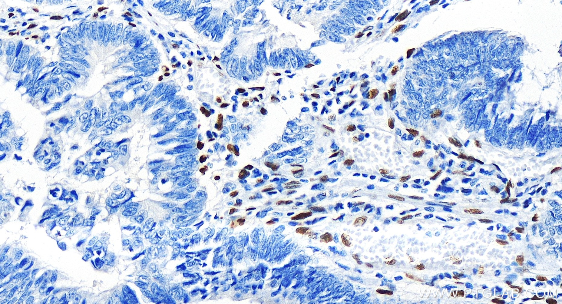 IHC staining of human colon cancer using 85729-1-RR