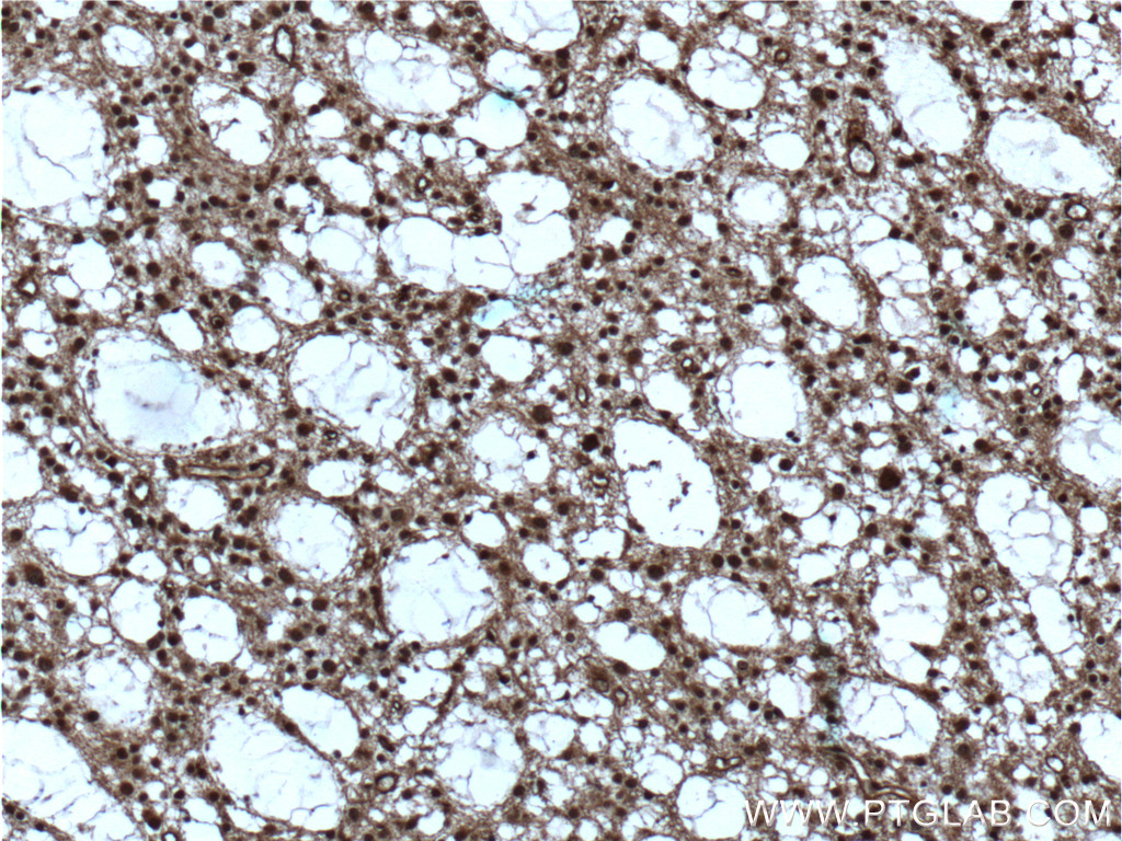 IHC staining of human gliomas using 14026-1-AP