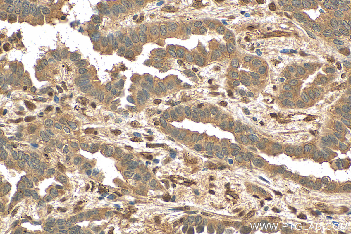 IHC staining of human lung cancer using 14026-1-AP