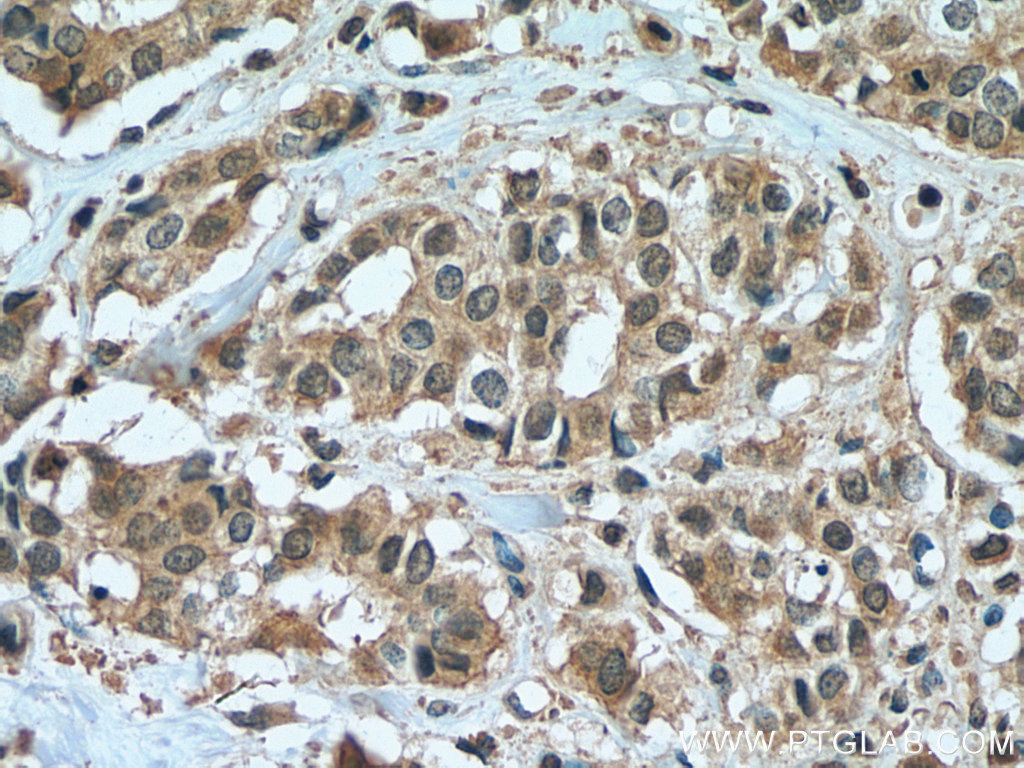 IHC staining of human breast cancer using 67514-1-Ig