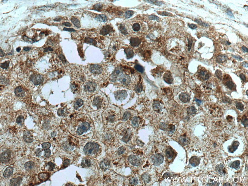 IHC staining of human breast cancer using 20157-1-AP