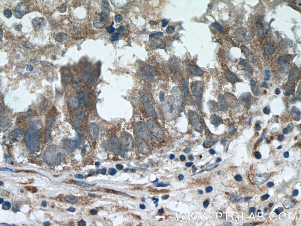 IHC staining of human breast cancer using 12737-1-AP