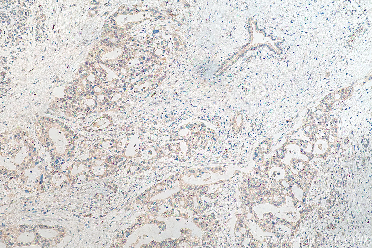 IHC staining of human pancreas cancer using 19005-1-AP