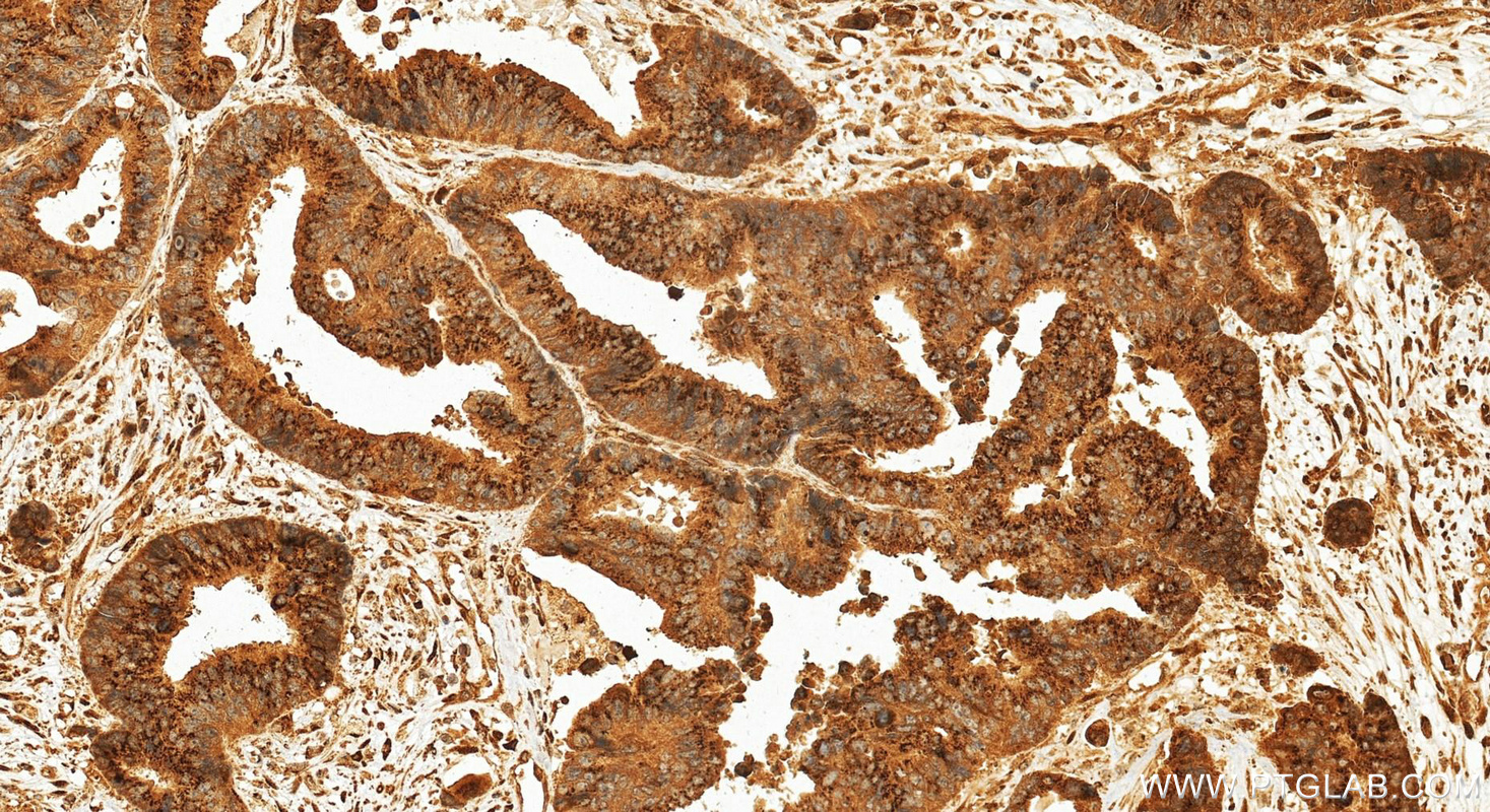Immunohistochemical analysis of paraffin-embedded human colon cancer tissue slide using 27157-1-AP (ZFPL1 antibody) at dilution of 1:200 (under 20x lens). Heat mediated antigen retrieval with Tris-EDTA buffer (pH 9.0). IHC staining of human colon cancer using 27157-1-AP