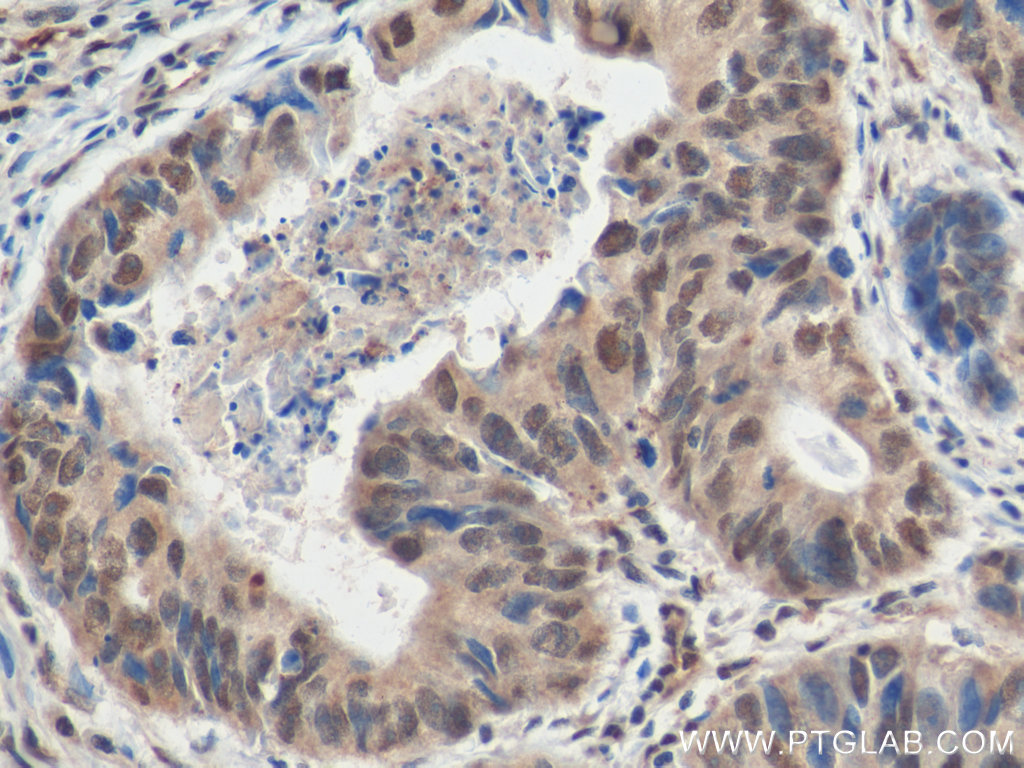 IHC staining of human colon cancer using 20136-1-AP