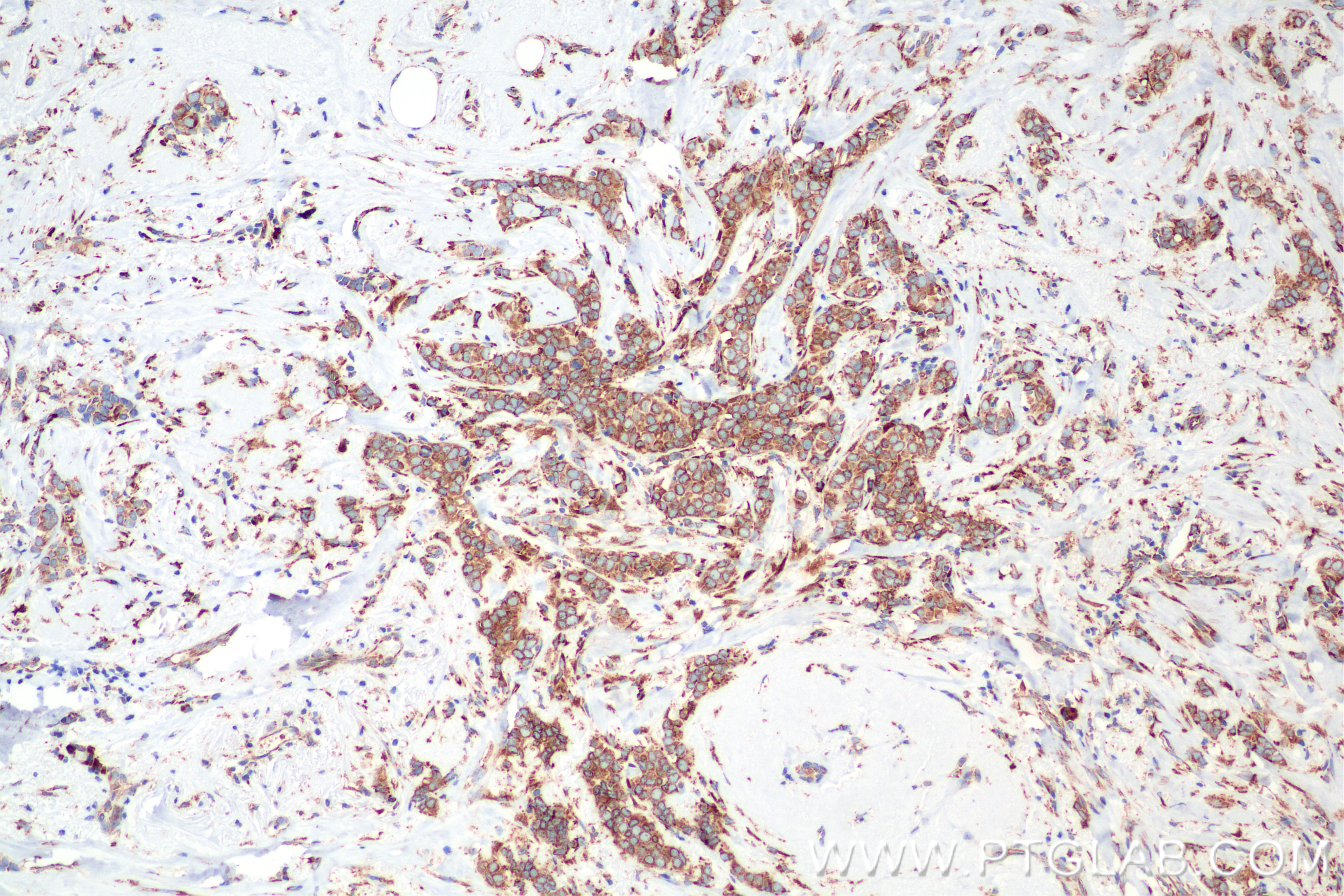 IHC staining of human breast cancer using 85383-1-RR