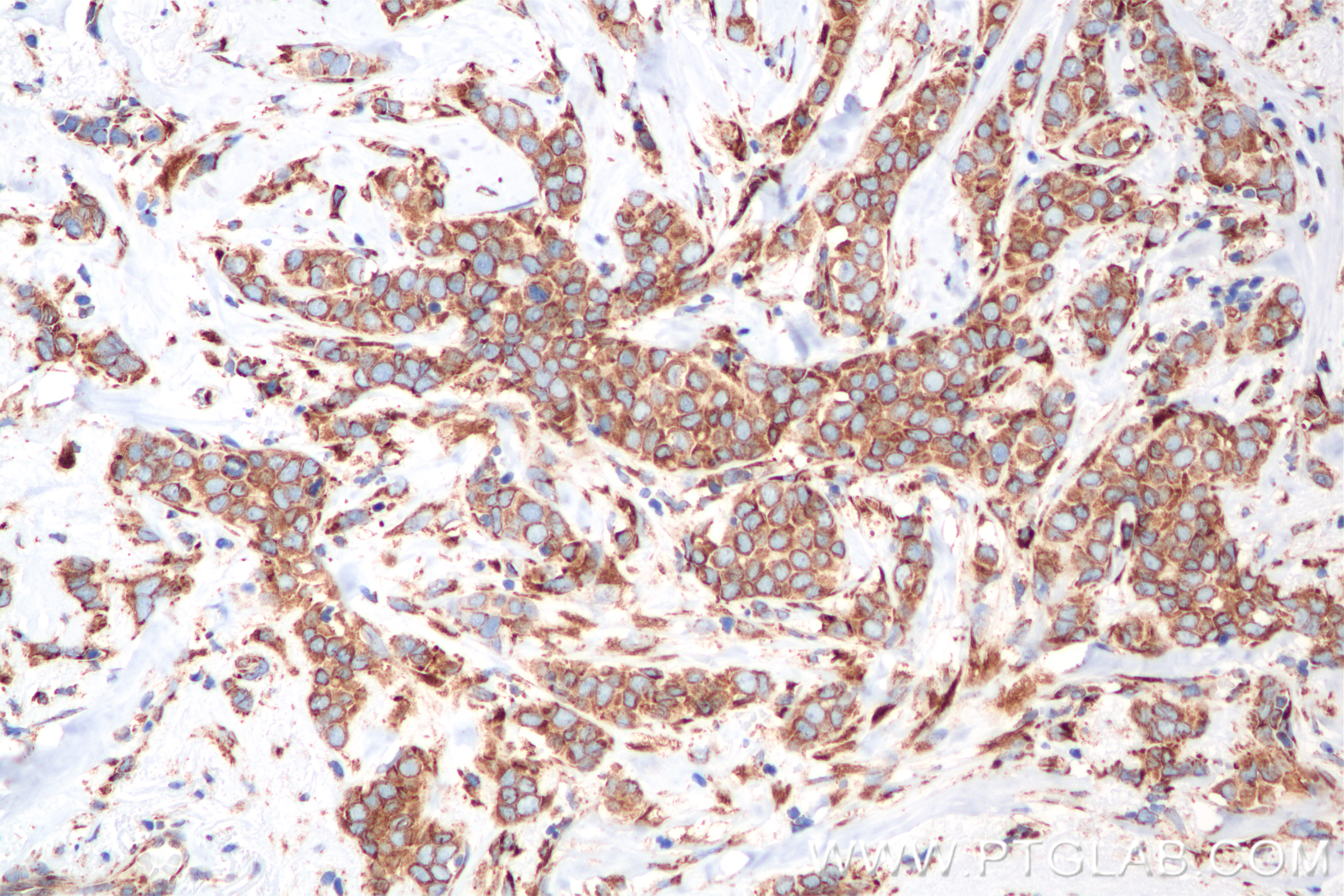 IHC staining of human breast cancer using 85383-1-RR