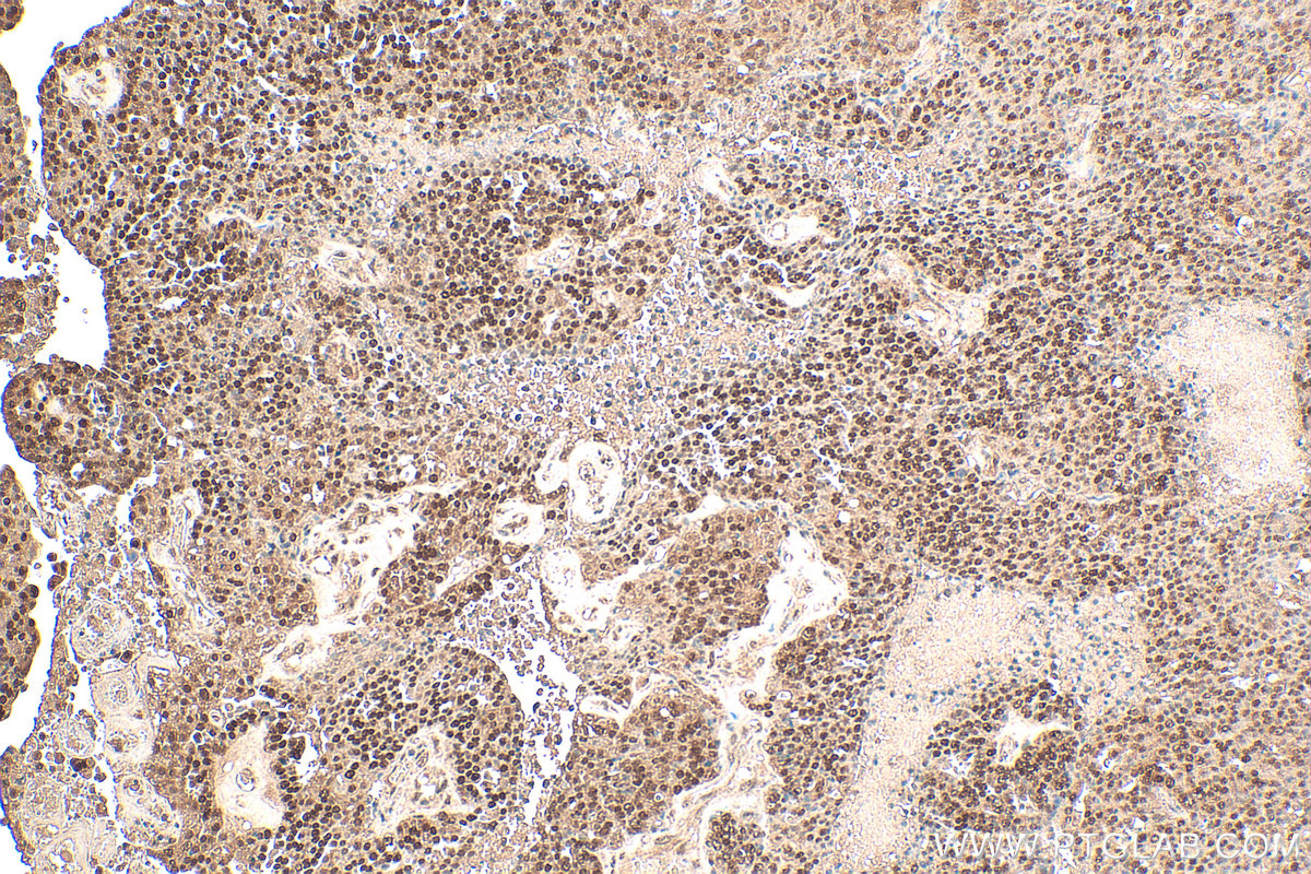 IHC staining of human ovary tumor using 25742-1-AP