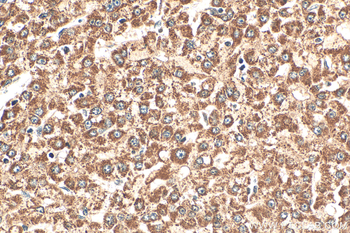 Immunohistochemical analysis of paraffin-embedded human liver cancer tissue slide using 14431-1-AP (ZMYND10 antibody) at dilution of 1:200 (under 40x lens). Heat mediated antigen retrieval with Tris-EDTA buffer (pH 9.0). IHC staining of human liver cancer using 14431-1-AP