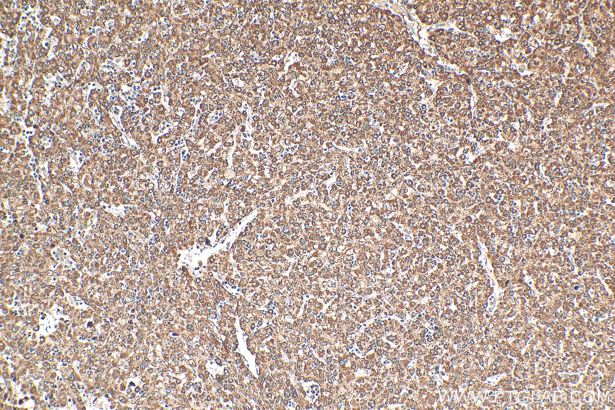 Immunohistochemical analysis of paraffin-embedded human liver cancer tissue slide using 14431-1-AP (ZMYND10 antibody) at dilution of 1:200 (under 10x lens). Heat mediated antigen retrieval with Tris-EDTA buffer (pH 9.0). IHC staining of human liver cancer using 14431-1-AP