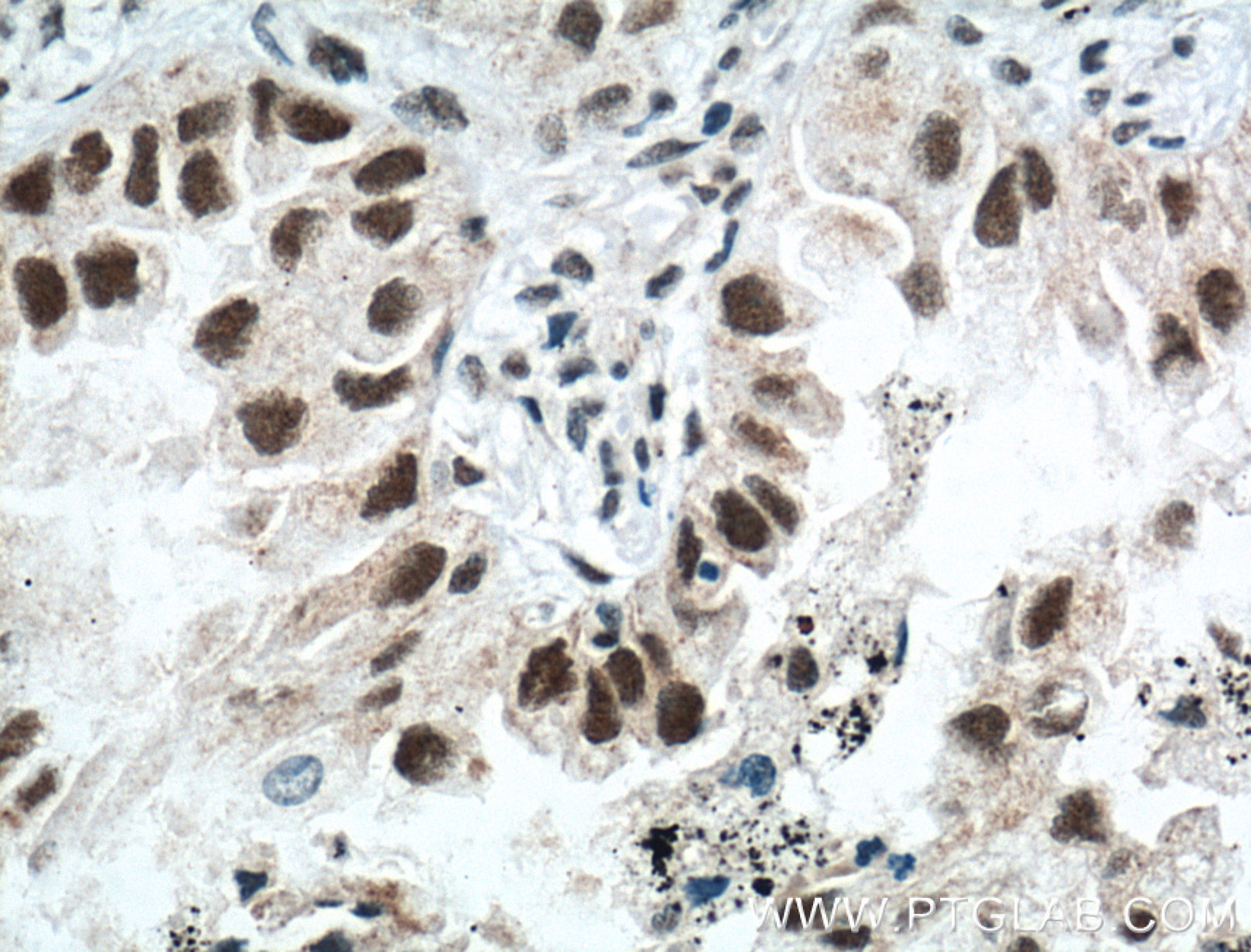 IHC staining of human lung cancer using 11633-1-AP