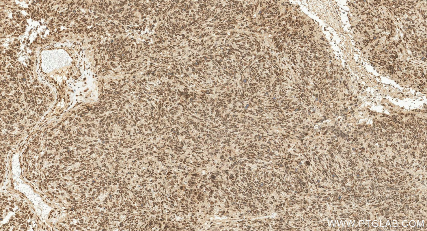 IHC staining of human gliomas using 25216-1-AP IHC staining of human gliomas using 25216-1-AP