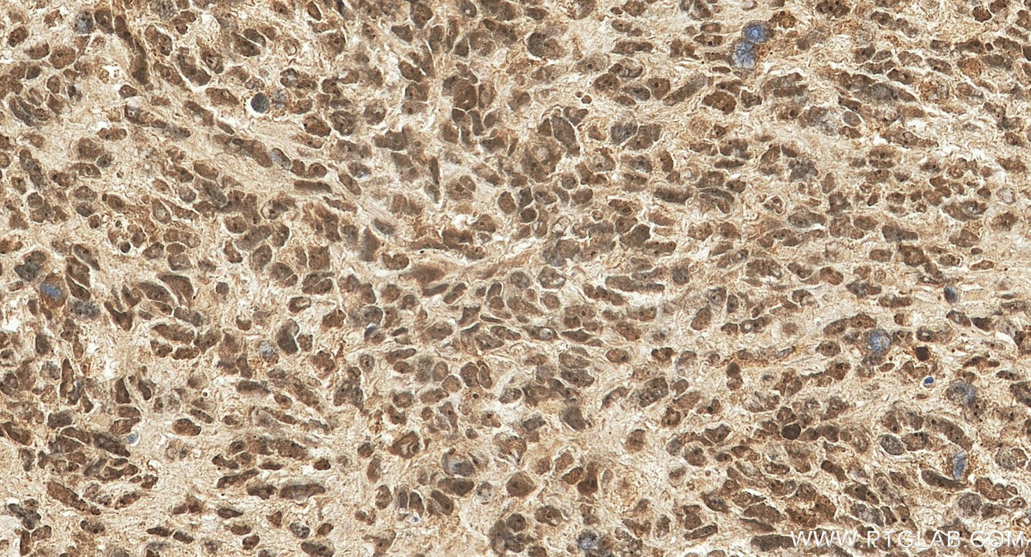 IHC staining of human gliomas using 25216-1-AP IHC staining of human gliomas using 25216-1-AP