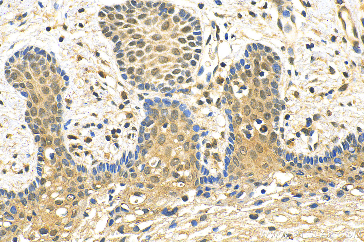 IHC staining of human cervical cancer using 31972-1-AP