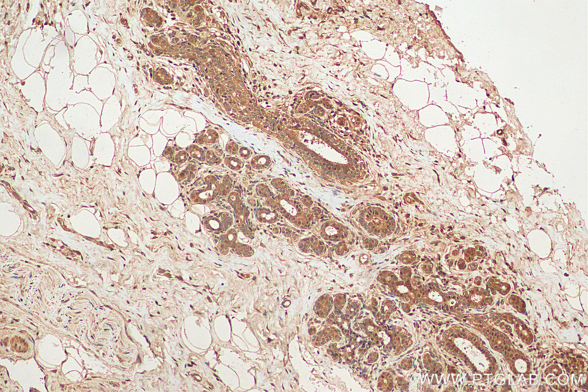 IHC staining of human breast cancer using 21075-1-AP