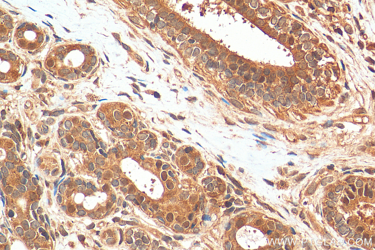 IHC staining of human breast cancer using 21075-1-AP