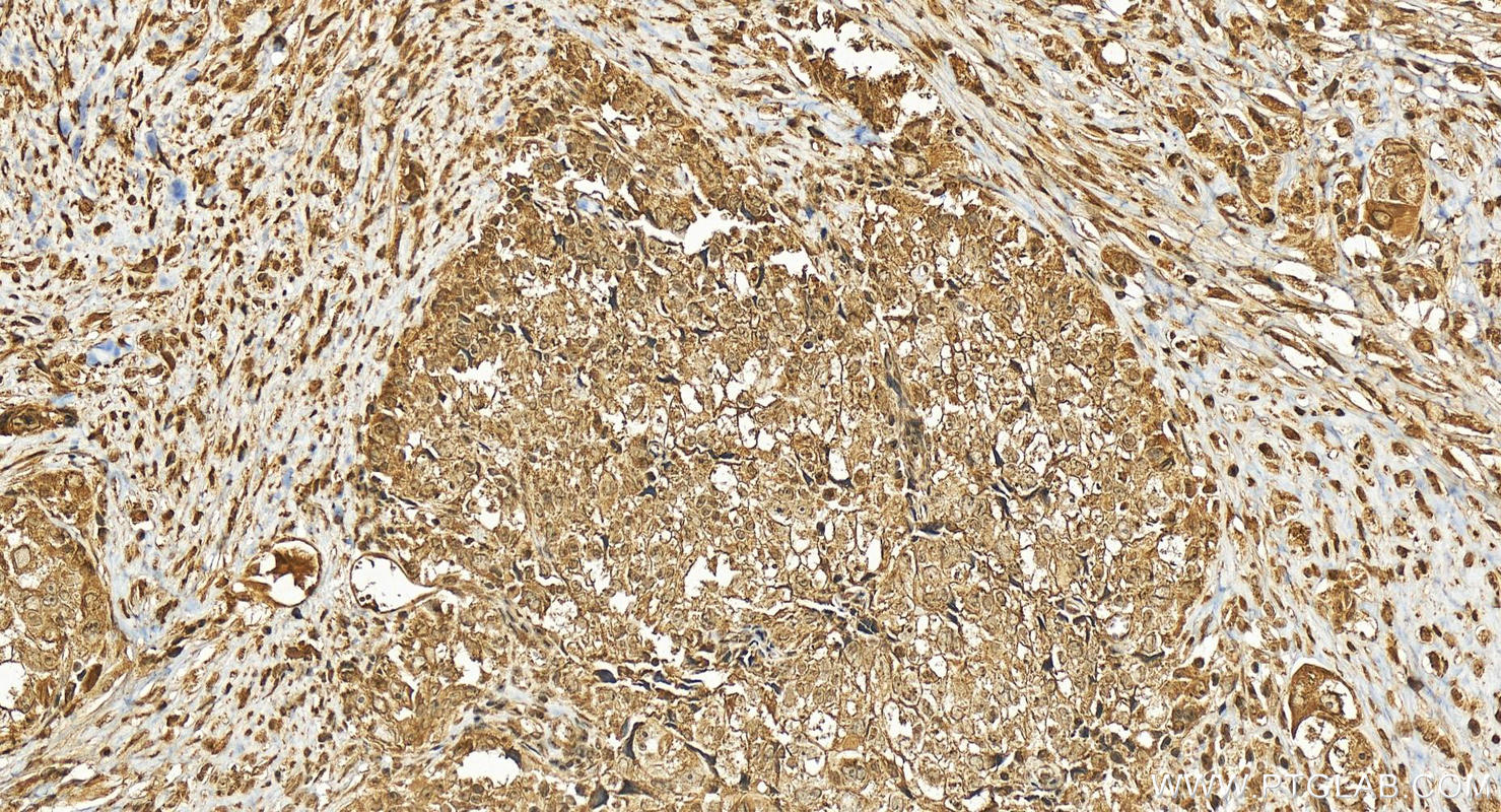 IHC staining of human ovary cancer using 25411-1-AP