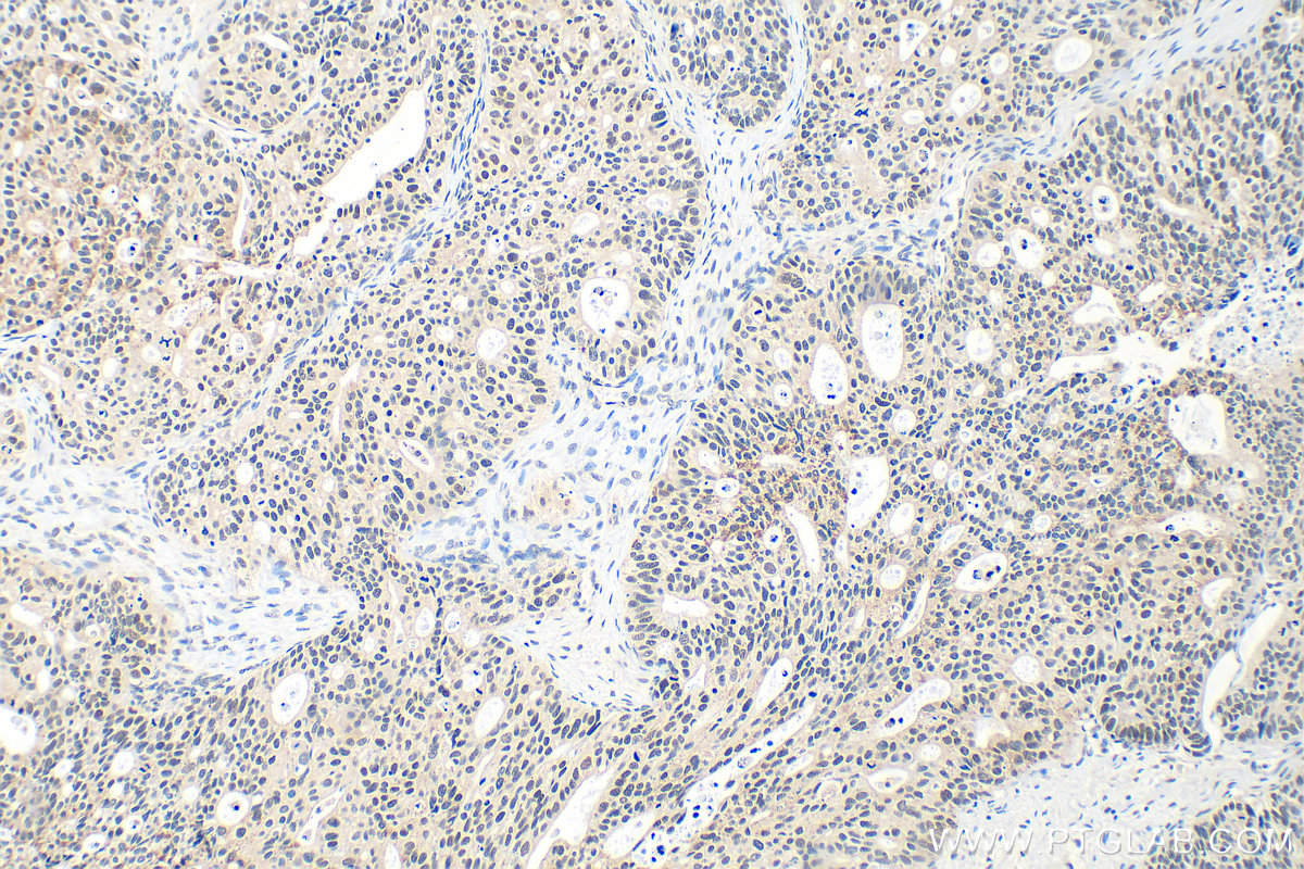IHC staining of human ovary tumor using 21221-1-AP