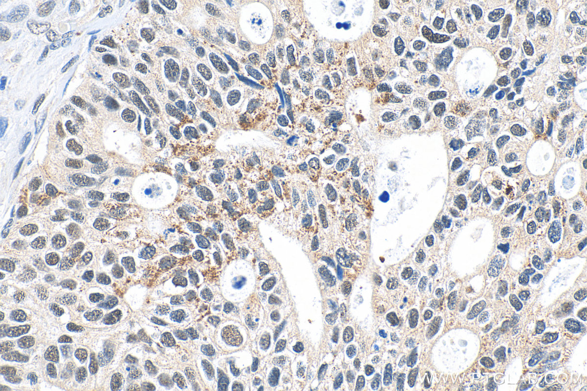 IHC staining of human ovary tumor using 21221-1-AP