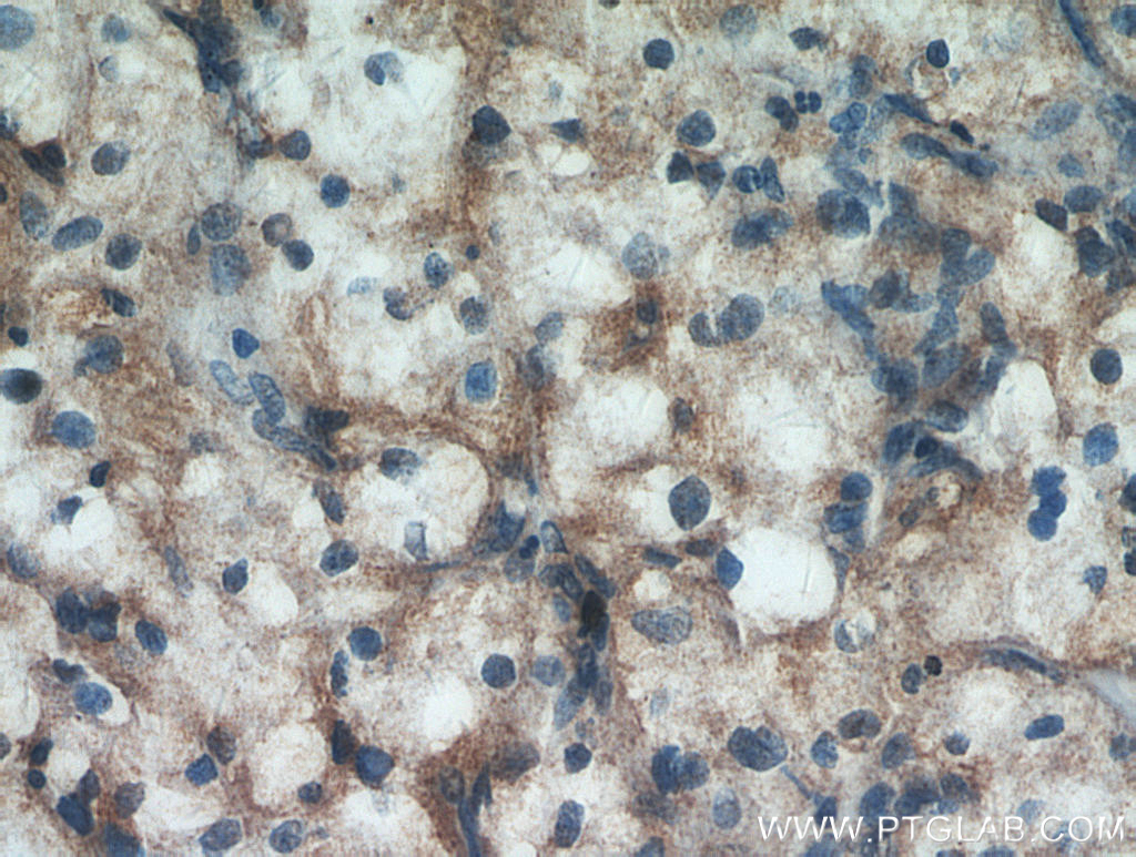 IHC staining of human renal cell carcinoma using 20539-1-AP