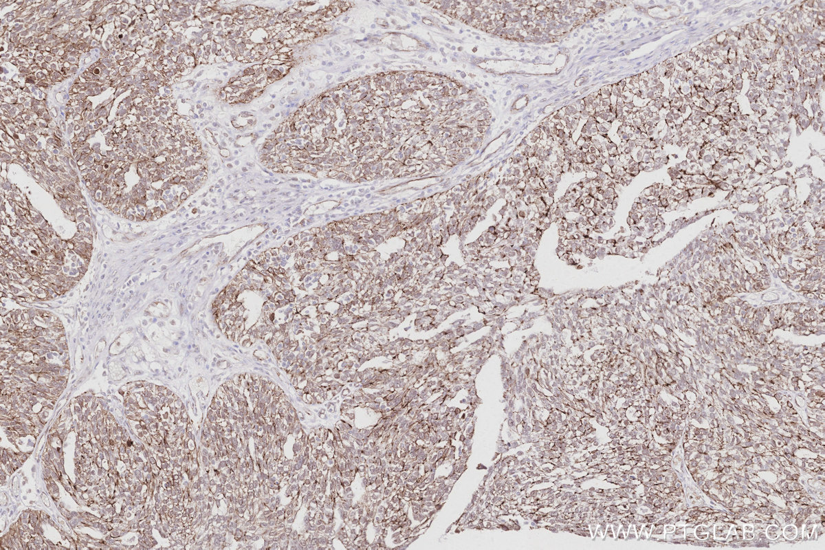IHC staining of human ovary cancer using 83111-4-RR (same clone as 83111-4-PBS) IHC staining of human ovary cancer using 83111-4-RR (same clone as 83111-4-PBS)