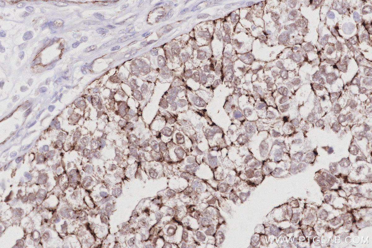IHC staining of human ovary cancer using 83111-4-RR