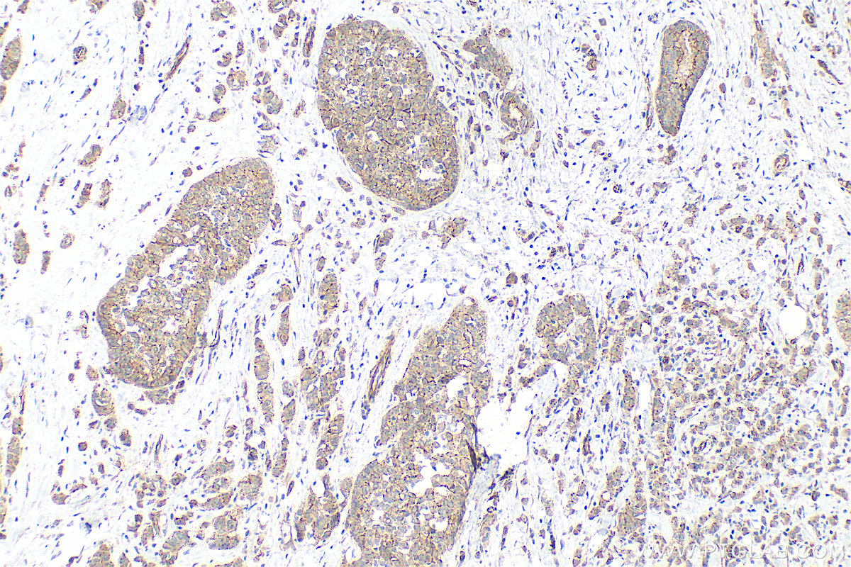 IHC staining of human breast cancer using 21773-1-AP IHC staining of human breast cancer using 21773-1-AP
