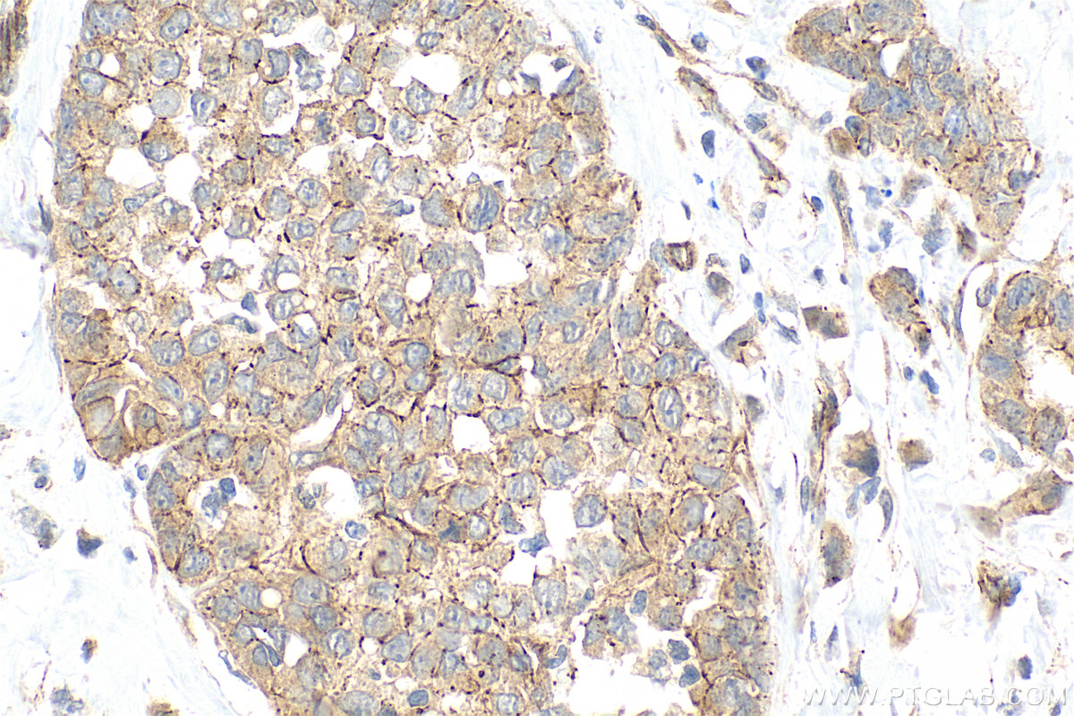 IHC staining of human breast cancer using 21773-1-AP IHC staining of human breast cancer using 21773-1-AP