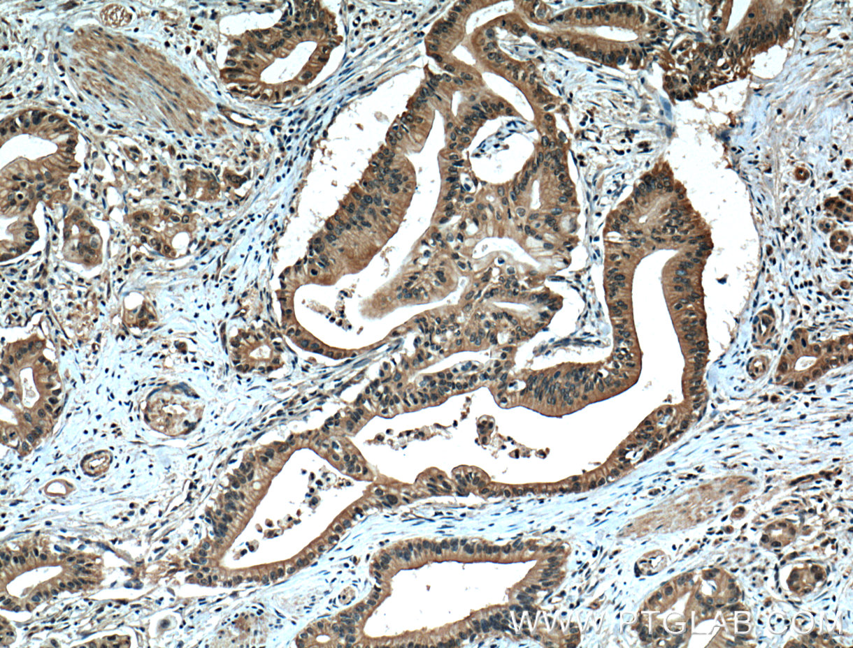 IHC staining of human pancreas cancer using 66452-1-Ig (same clone as 66452-1-PBS)