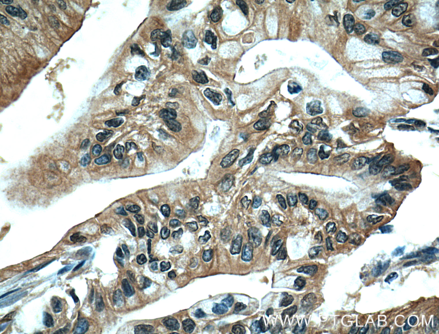 IHC staining of human pancreas cancer using 66452-1-Ig (same clone as 66452-1-PBS)