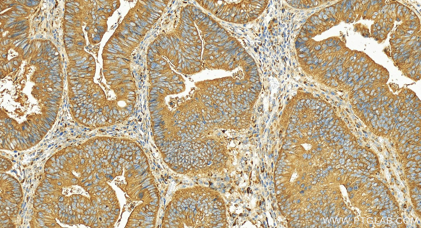 IHC staining of human colon cancer using 14281-1-AP