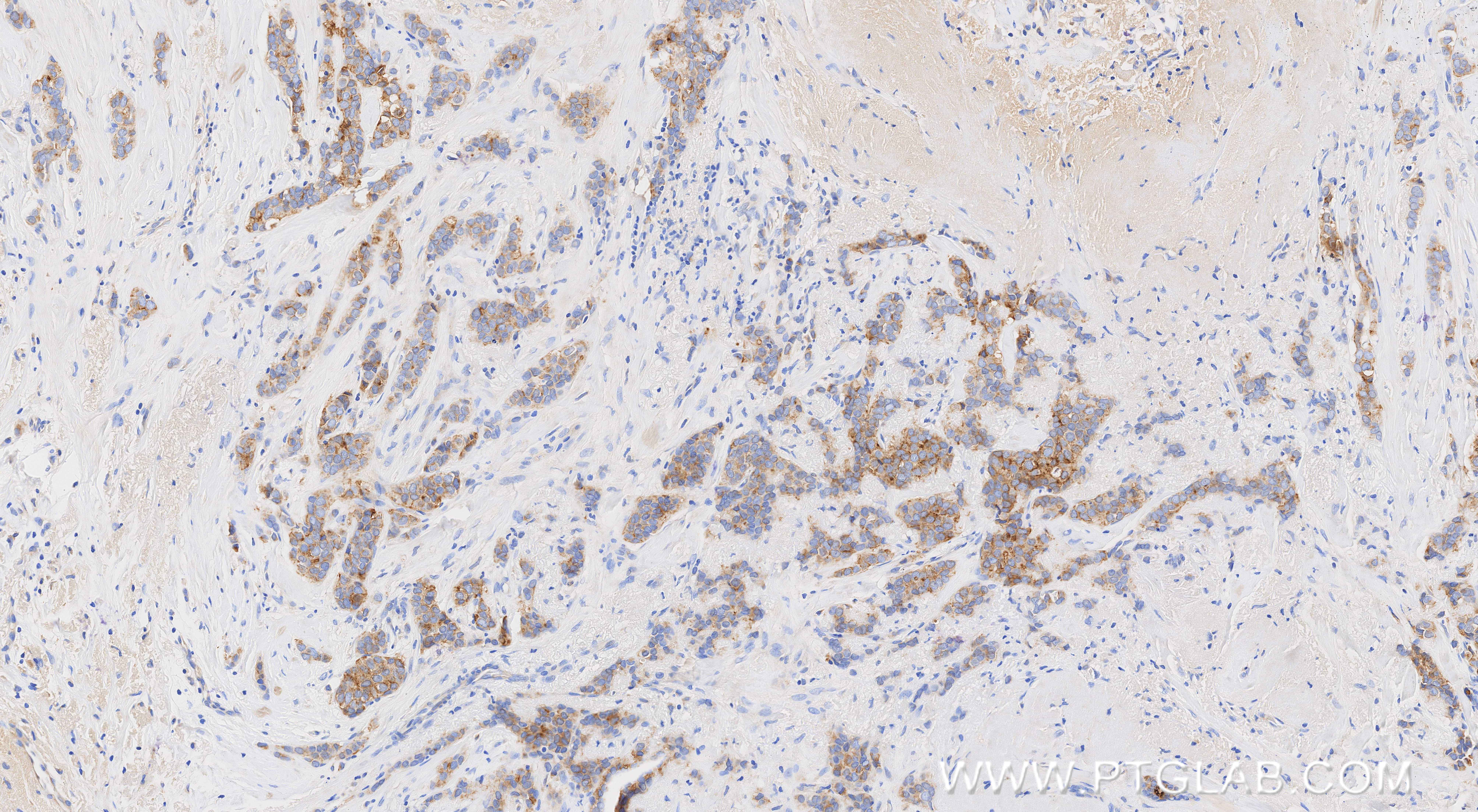 IHC staining of human breast cancer using 86781-3-RR (same clone as 86781-3-PBS) IHC staining of human breast cancer using 86781-3-RR (same clone as 86781-3-PBS)