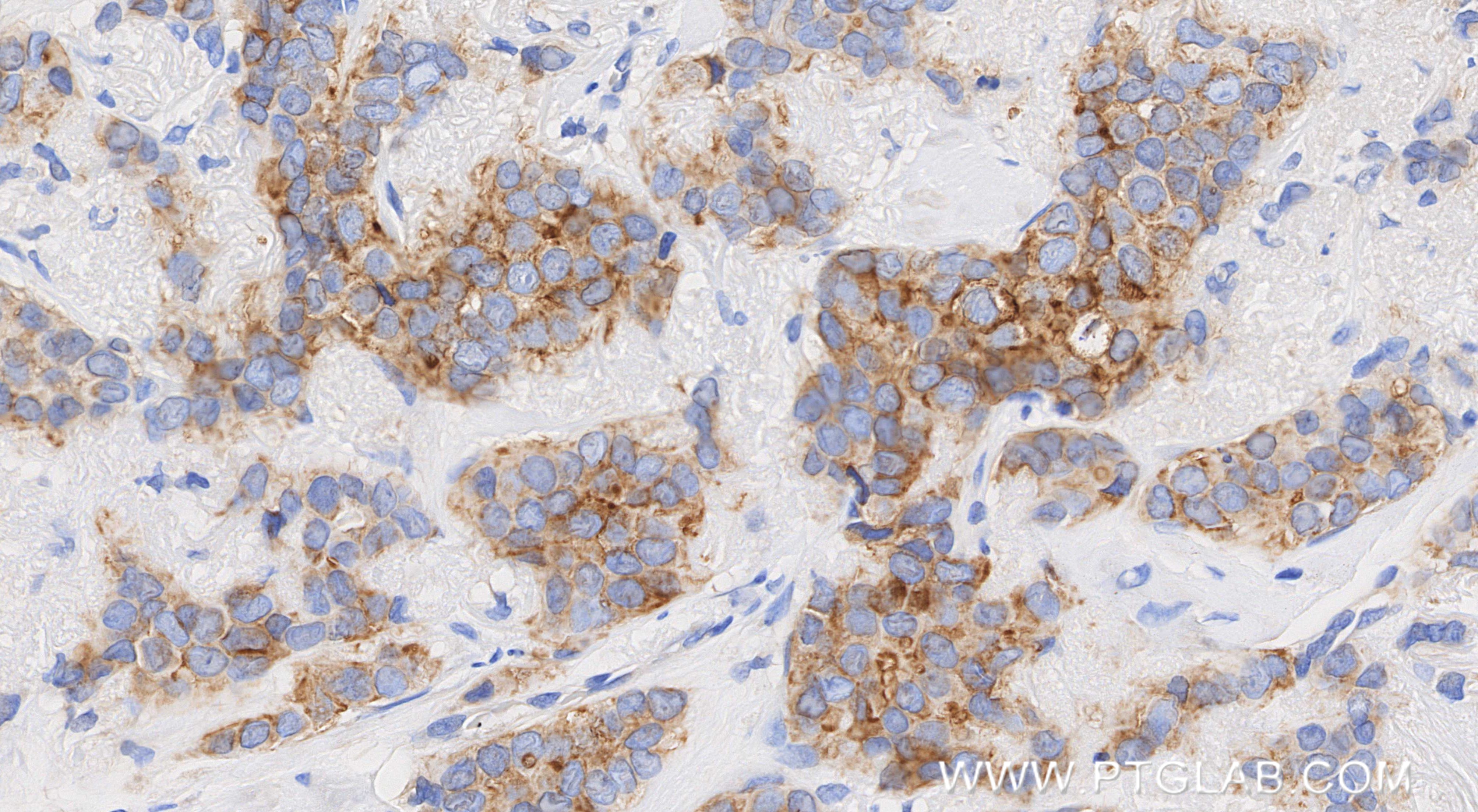 IHC staining of human breast cancer using 86781-3-RR (same clone as 86781-3-PBS) IHC staining of human breast cancer using 86781-3-RR (same clone as 86781-3-PBS)